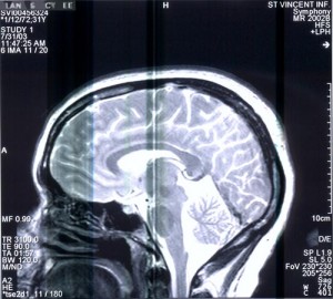 epilepsy brain damage